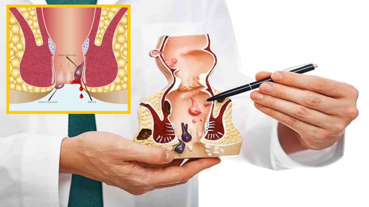 Piles Problem : ఫైల్స్ సమస్యా? తీసుకునే ఆహారంలో! Piles Problem : ఫైల్స్ సమస్యా? తీసుకునే ఆహారంలో!