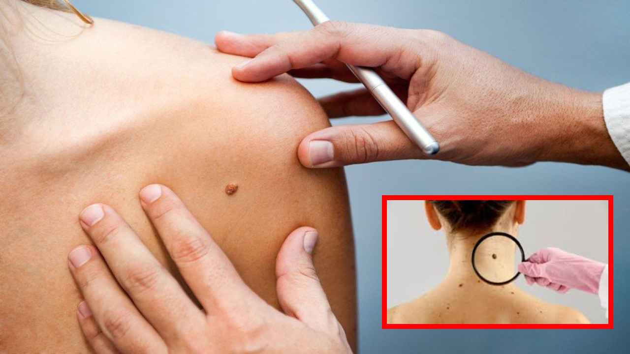 Pimples and Moles : పులిపిర్లు, పుట్టుమచ్చలతో జాగ్రత్త! క్యాన్సర్లుగా మారే ఛాన్స్? Pimples and Moles : పులిపిర్లు, పుట్టుమచ్చలతో జాగ్రత్త! క్యాన్సర్లుగా మారే ఛాన్స్?