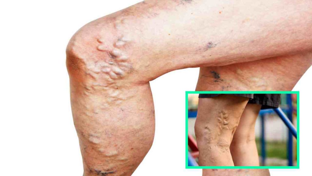 Varicose Veins