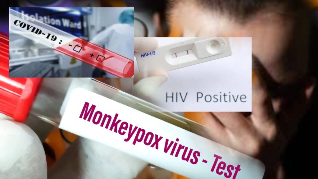 36 Years old Italian man tests positive for COVID, Monkeypox and HIV