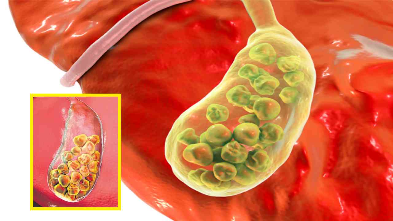 Gallstones : పిత్తాశయంలో రాళ్ల సమస్యకు కారణాలు ఇవే! Gallstones : పిత్తాశయంలో రాళ్ల సమస్యకు కారణాలు ఇవే!