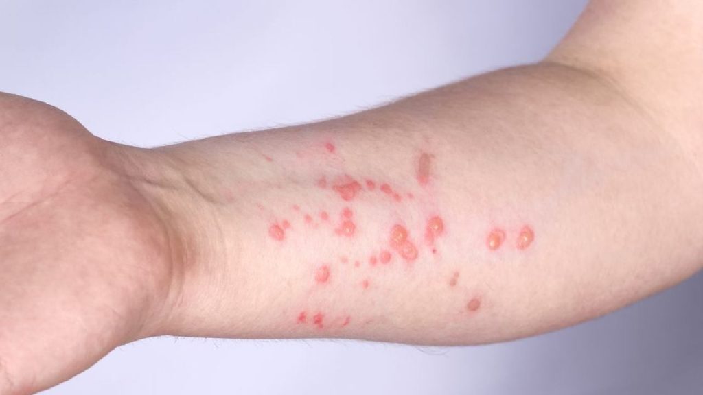 Monkeypox