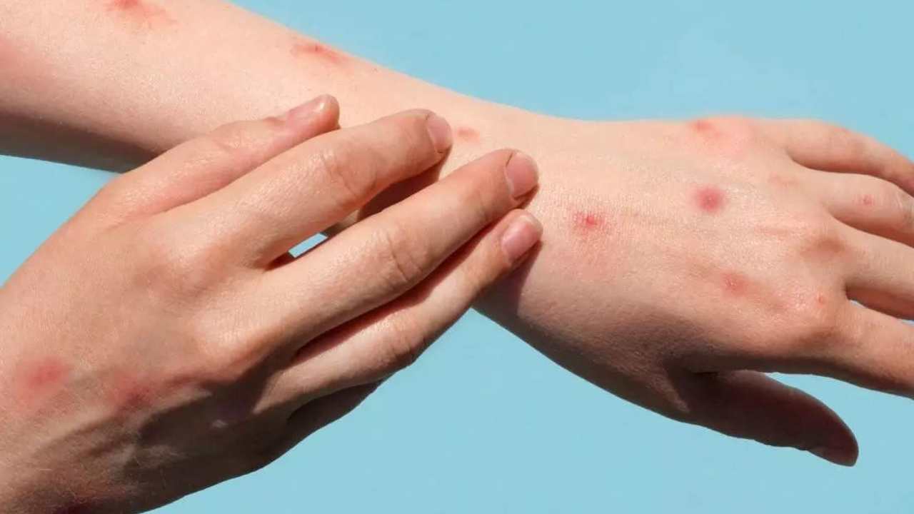 Monkeypox: దేశంలో తొమ్మిదో మంకీపాక్స్ కేసు నమోదు Monkeypox: దేశంలో తొమ్మిదో మంకీపాక్స్ కేసు నమోదు