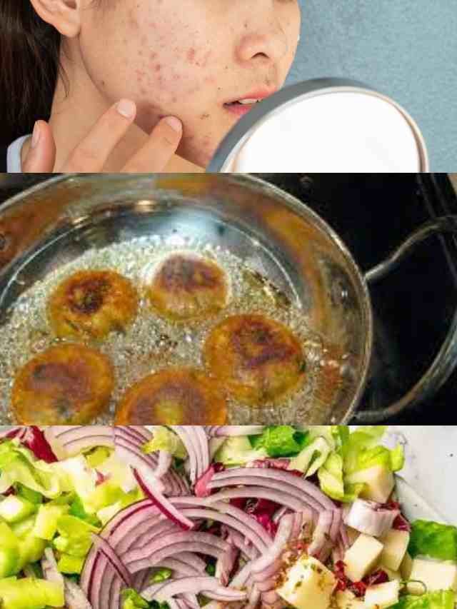 >మొటిమలకి కారణాలు..!