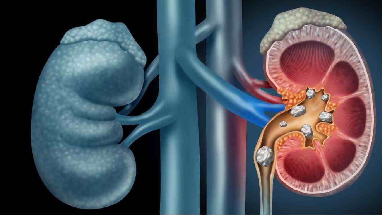 Calcium and Potassium-rich diets: కిడ్నీల్లో రాళ్ళు ఏర్పడకుండా ఇలా చెక్ పెట్టొచ్చు.. గుర్తించిన పరిశోధకులు Calcium and Potassium-rich diets: కిడ్నీల్లో రాళ్ళు ఏర్పడకుండా ఇలా చెక్ పెట్టొచ్చు.. గుర్తించిన పరిశోధకులు