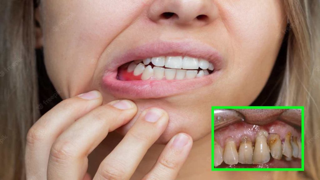 gum disease occur