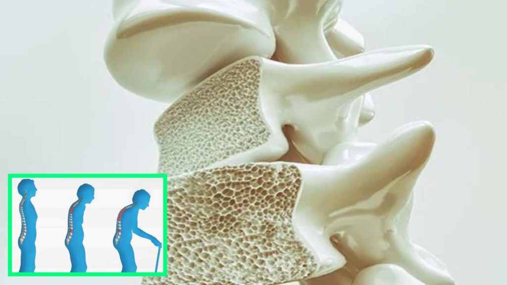 osteoporosis in the aging population