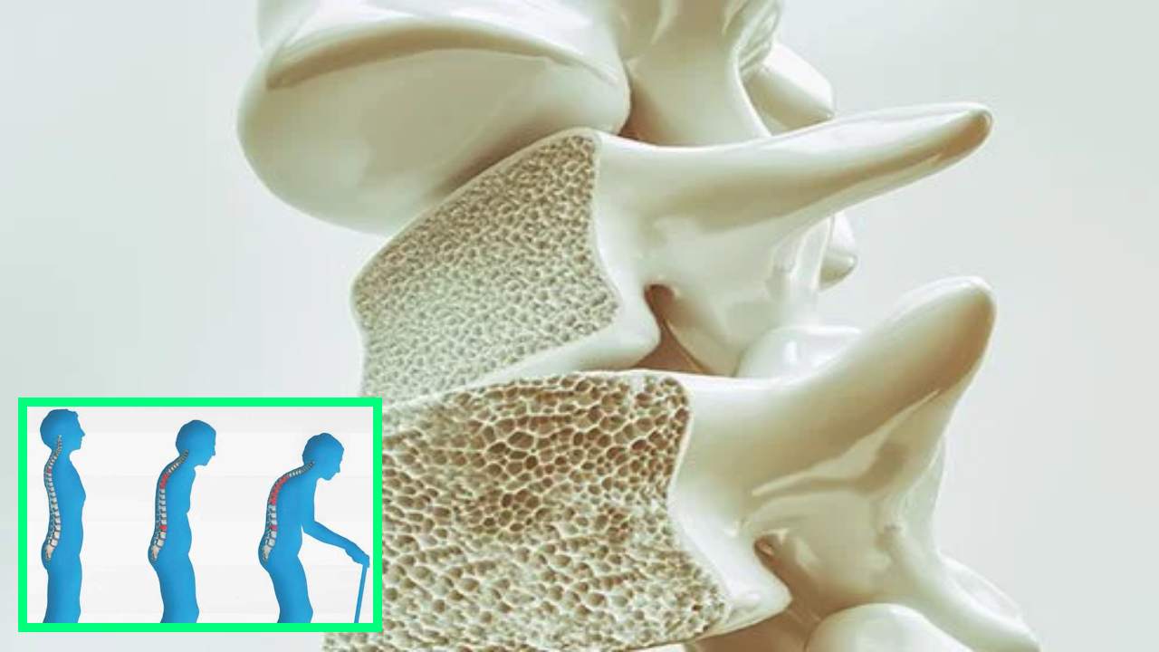 Osteoporosis : వయస్సు పెరుగుతున్న వారిలో బోలు ఎముకల సమస్య ఎందుకంటే? Osteoporosis : వయస్సు పెరుగుతున్న వారిలో బోలు ఎముకల సమస్య ఎందుకంటే?