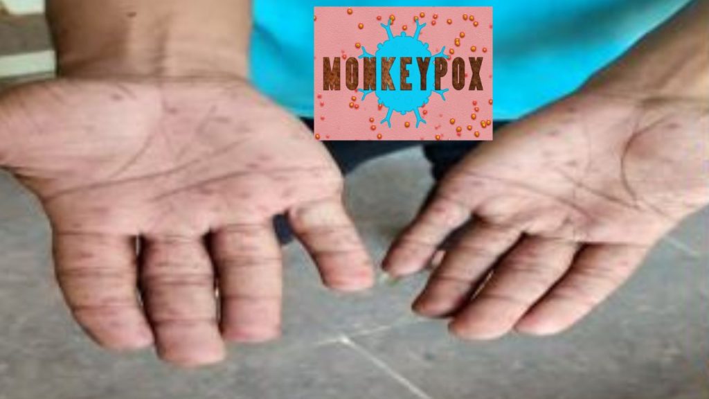 young man monkeypox
