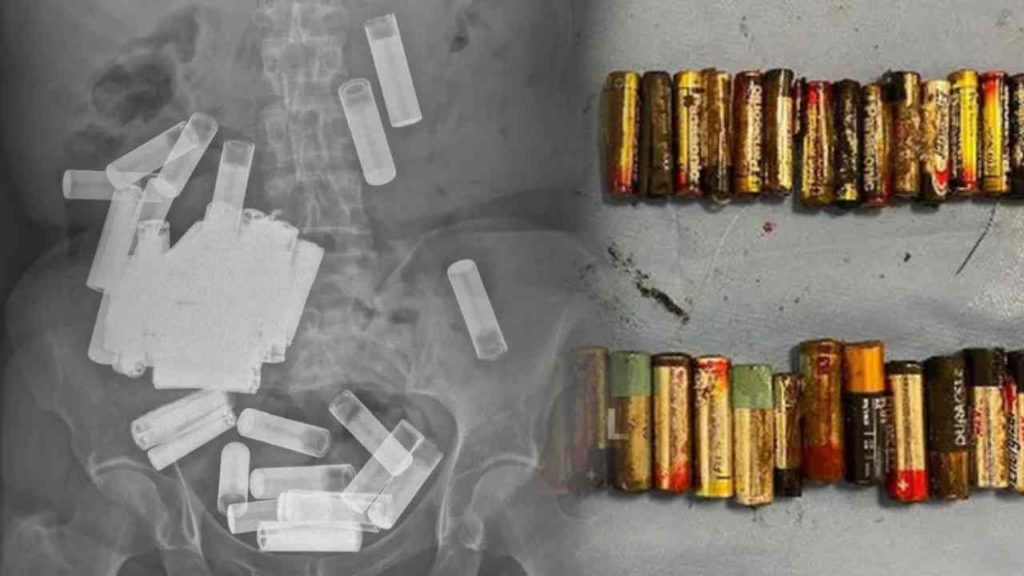 Batteries In Woman Stomach