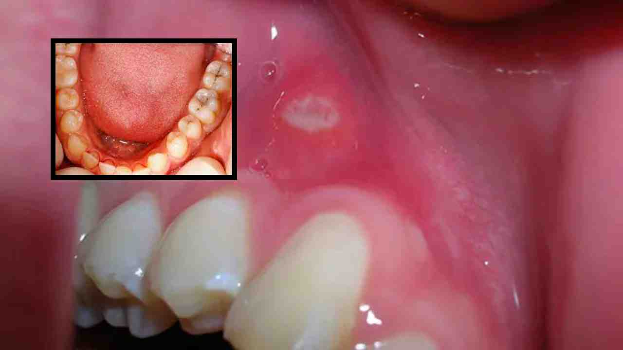 Mouth Cancer : నోటిలో క్యాన్సర్ పెరుగుదలను సూచించే సూక్ష్మ సంకేతాలు ఇవే! Mouth Cancer : నోటిలో క్యాన్సర్ పెరుగుదలను సూచించే సూక్ష్మ సంకేతాలు ఇవే!