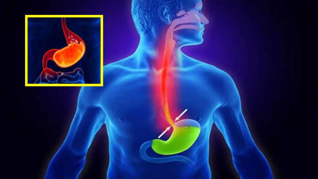 Stomach Acid Reflux