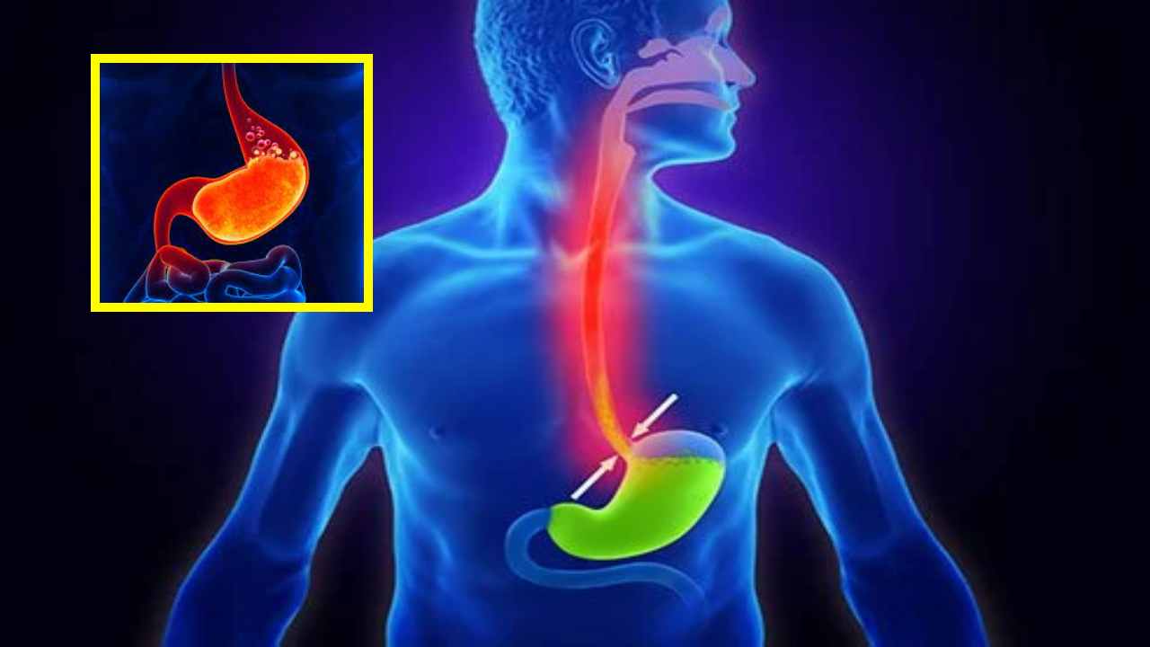 Stomach Acid Reflux : పొట్టలో గ్యాస్, మంటలకు యాసిడ్ రిఫ్లక్స్ కారణమా? దీనిని నివారించాలంటే ! Stomach Acid Reflux : పొట్టలో గ్యాస్, మంటలకు యాసిడ్ రిఫ్లక్స్ కారణమా? దీనిని నివారించాలంటే !