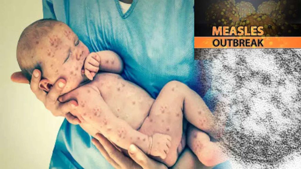 Zimbabwe Govt Says Measles Outbreak Has Killed 700 Children