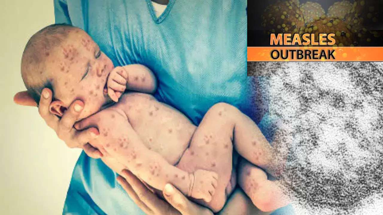 Measles In Zimbabwe : జింబాబ్వేలో 6,291 మీజిల్స్ వ్యాధి కేసులు .. 700 మంది చిన్నారులు మృతి.. Measles In Zimbabwe : జింబాబ్వేలో 6,291 మీజిల్స్ వ్యాధి కేసులు .. 700 మంది చిన్నారులు మృతి..