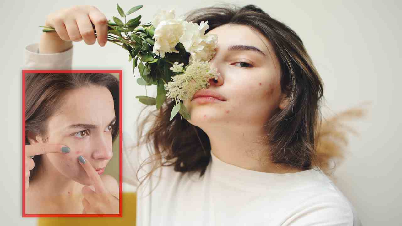 Hormonal Acne : ఆడవారిలో మొటిమల సమస్య ఎందుకు వస్తుంది? సమస్య నుండి సులభంగా బయటపడటమెలా? Hormonal Acne : ఆడవారిలో మొటిమల సమస్య ఎందుకు వస్తుంది? సమస్య నుండి సులభంగా బయటపడటమెలా?