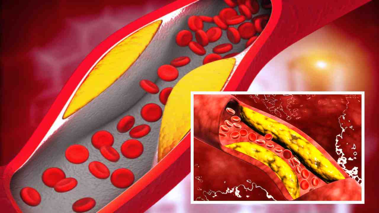 Cholesterol : శరీరంలో కొలెస్ట్రాల్ అవసరత ఎంత? దాని మోతాదులు మించితే ఏమౌతుంది? Cholesterol : శరీరంలో కొలెస్ట్రాల్ అవసరత ఎంత? దాని మోతాదులు మించితే ఏమౌతుంది?
