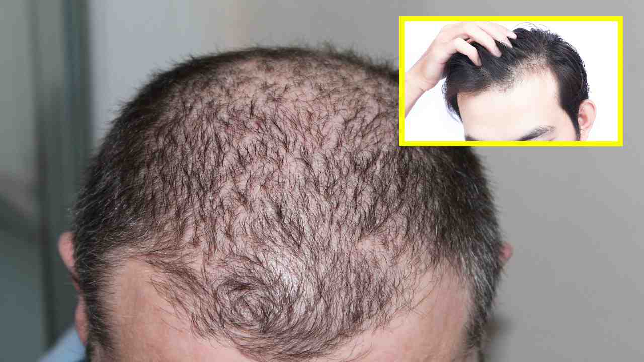 Hair Loss : జుట్టు ఊడిపోవటానికి శరీరంలో పోషకాలు లోపమే కారణమా? ఎలాంటి జాగ్రత్తలు పాటిస్తే మేలంటే! Hair Loss : జుట్టు ఊడిపోవటానికి శరీరంలో పోషకాలు లోపమే కారణమా? ఎలాంటి జాగ్రత్తలు పాటిస్తే మేలంటే!