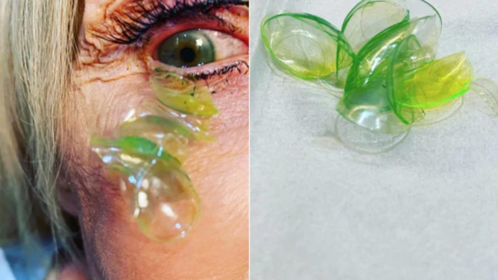 Contact Lense