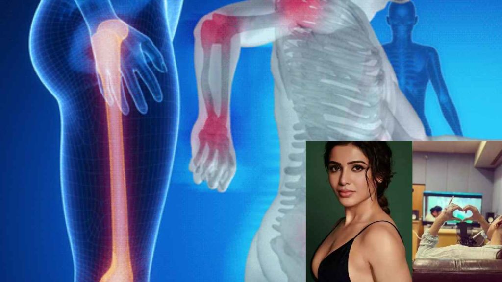 What is myositis