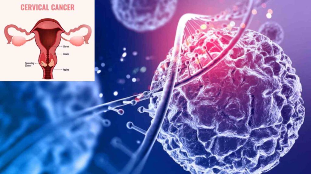 cervical cancer