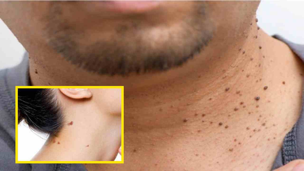 Home Remedies For Pulipirlu : పులిపిర్లు సమస్యతో బాధపడుతుంటే సులభమైన గృహచిట్కాలతో సమస్యను తొలగించుకోండి! Home Remedies For Pulipirlu : పులిపిర్లు సమస్యతో బాధపడుతుంటే సులభమైన గృహచిట్కాలతో సమస్యను తొలగించుకోండి!