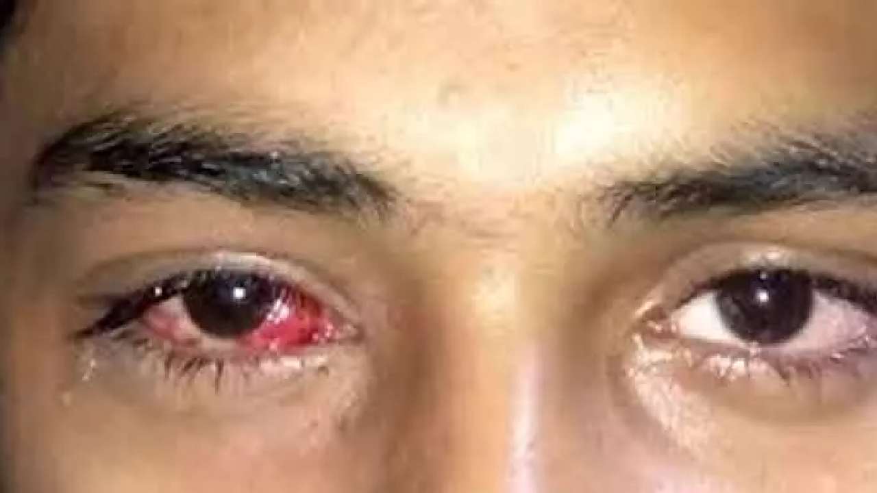 ‘Madras Eye’: తమిళనాడులో ప్రబలుతున్న ‘మద్రాస్ ఐ’.. అప్రమత్తంగా ఉండాలని ప్రభుత్వం సూచనలు ‘Madras Eye’: తమిళనాడులో ప్రబలుతున్న ‘మద్రాస్ ఐ’.. అప్రమత్తంగా ఉండాలని ప్రభుత్వం సూచనలు