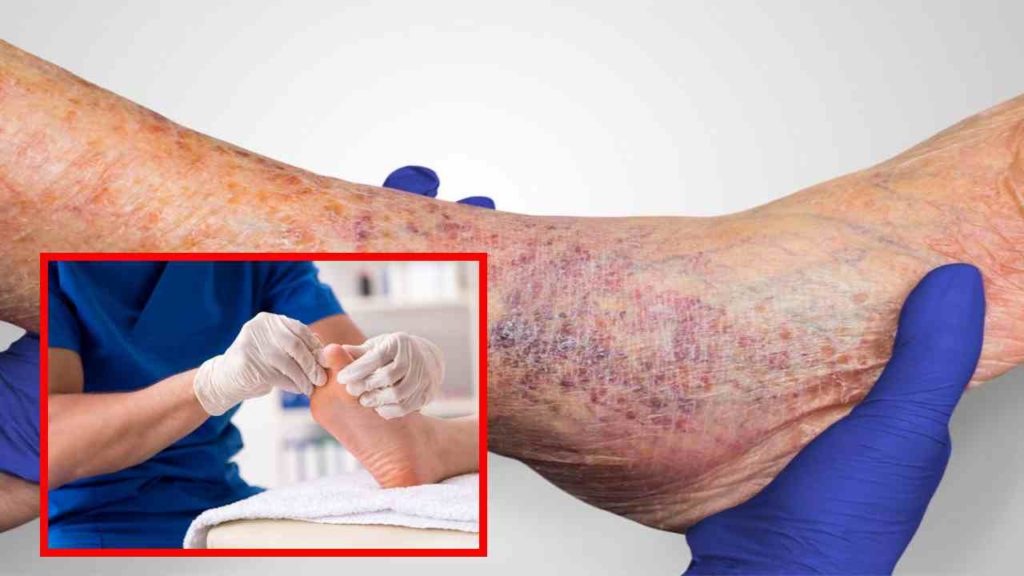 Natural tips to prevent leg ulcers in people with diabetes!