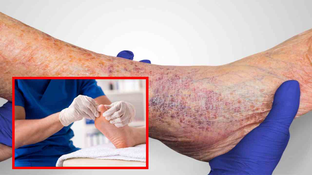 Leg Ulcers : మధుమేహ సమస్య ఉన్నవారిలో కాళ్లకు పుళ్లు పడితే వాటిని నివారించే సహజ చిట్కాలు! Leg Ulcers : మధుమేహ సమస్య ఉన్నవారిలో కాళ్లకు పుళ్లు పడితే వాటిని నివారించే సహజ చిట్కాలు!