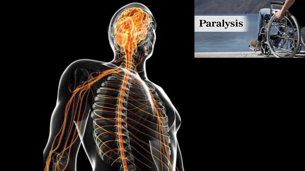 paralysis