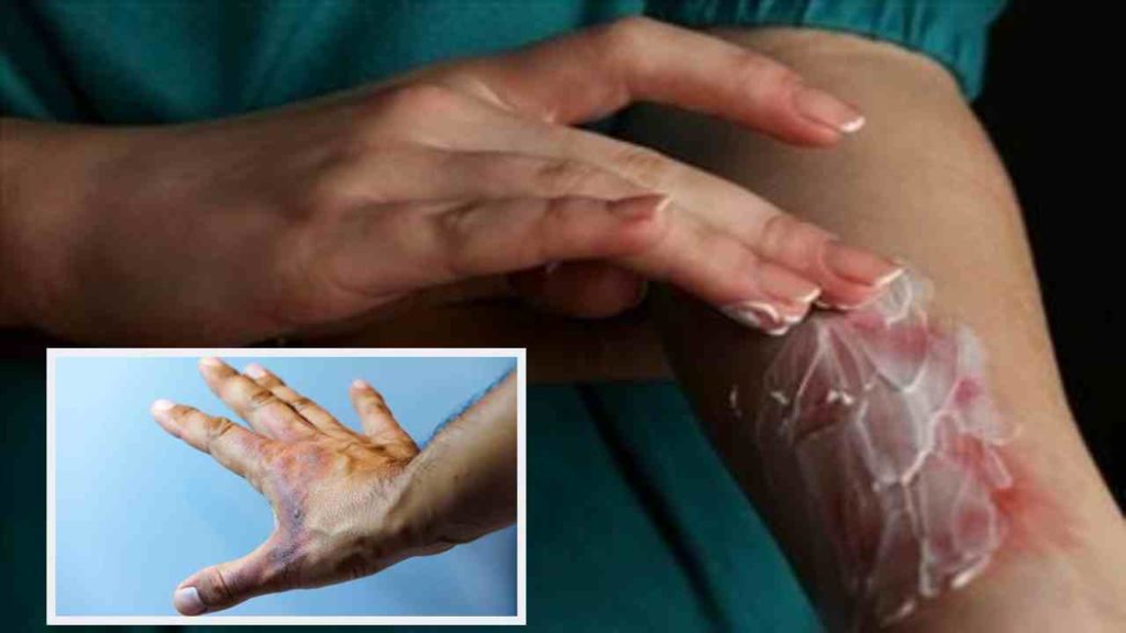 Blisters and burns on the body to heal quickly?