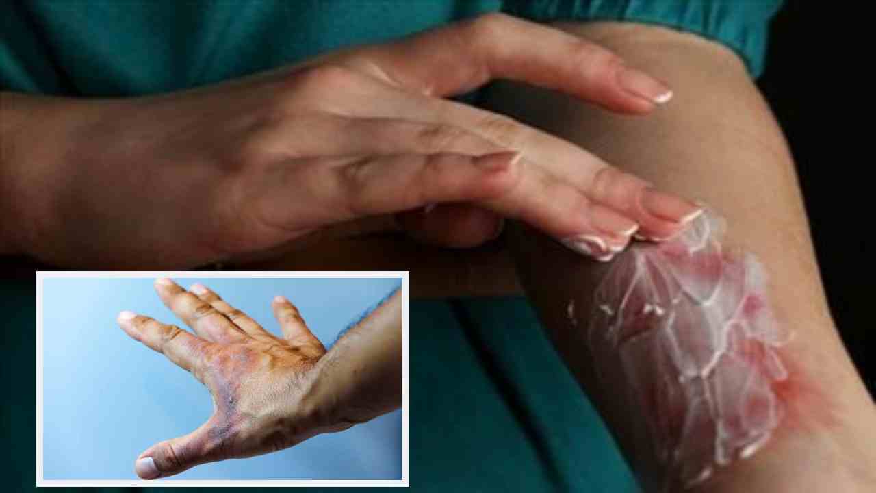 Burn Blister : శరీరంపై ఏర్పడే బొబ్బలు, కాలిన గాయాలు త్వరగా మానాలంటే? Burn Blister : శరీరంపై ఏర్పడే బొబ్బలు, కాలిన గాయాలు త్వరగా మానాలంటే?