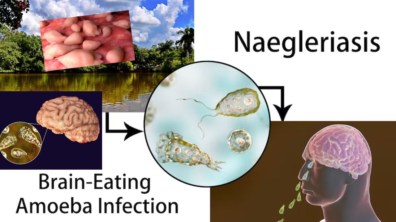 Brain Eating Amoeba : మెదడును తినేసే అమీబా..! మరో వ్యక్తి మృతి..ప్రపంచానికి మరో కొత్త వైరస్ ఆందోళన Brain Eating Amoeba : మెదడును తినేసే అమీబా..! మరో వ్యక్తి మృతి..ప్రపంచానికి మరో కొత్త వైరస్ ఆందోళన