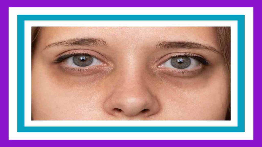 Dark Circles Under Eyes