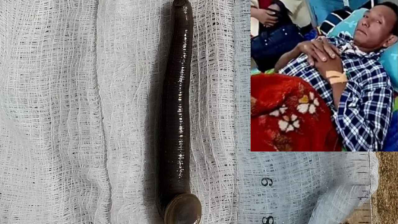 Leech In Trachea : బాబోయ్.. గొంతులో ఇరుక్కుపోయిన జలగ, 15 రోజులైనా బతికే ఉంది Leech In Trachea : బాబోయ్.. గొంతులో ఇరుక్కుపోయిన జలగ, 15 రోజులైనా బతికే ఉంది