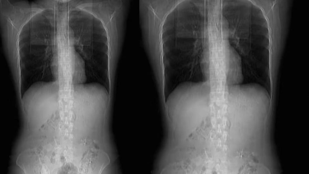 Woman fractures 4 ribs while coughing