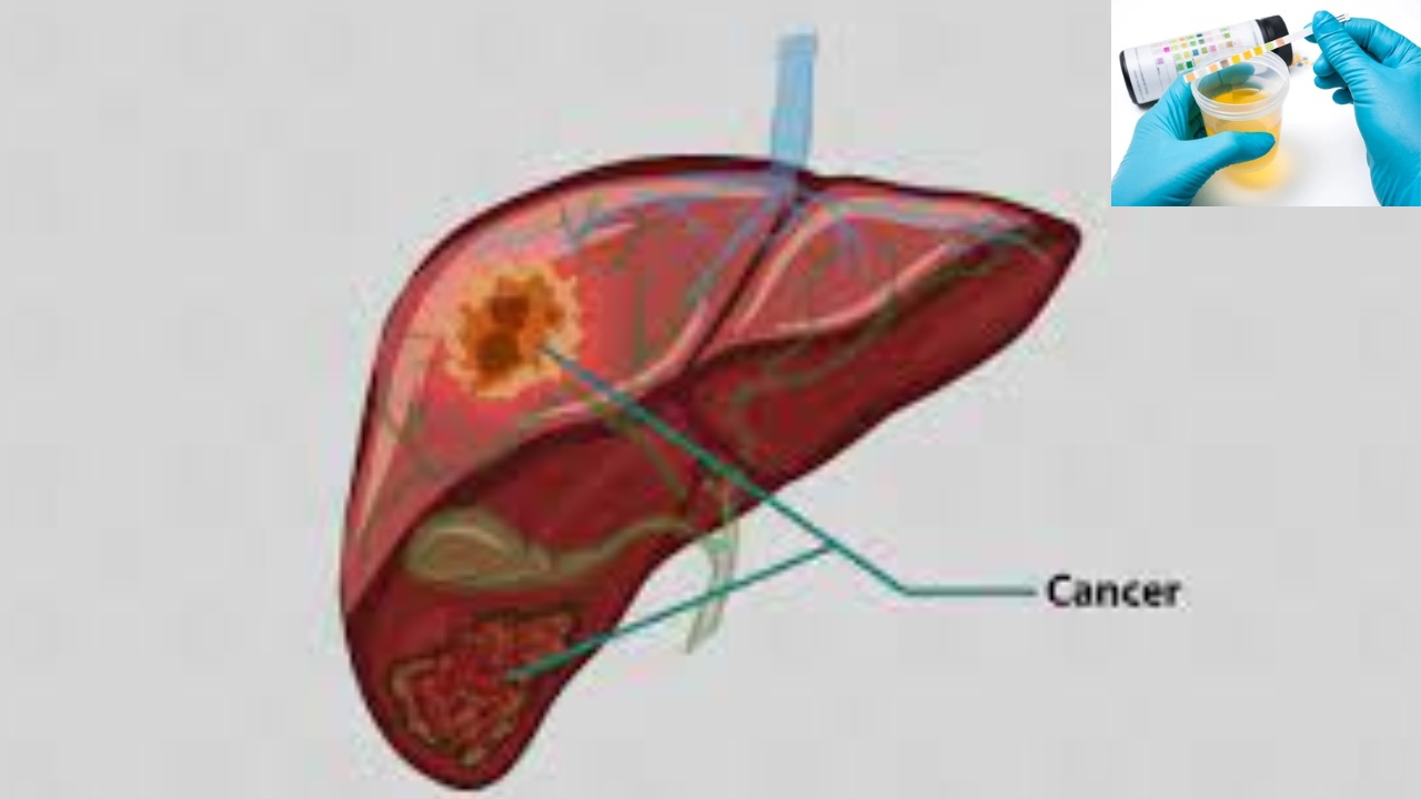 Liver Cancer Detect Urine Test : మూత్ర పరీక్షతో కాలేయ క్యాన్సర్ గుర్తింపు.. ప్రపంచంలోనే తొలిసారి Liver Cancer Detect Urine Test : మూత్ర పరీక్షతో కాలేయ క్యాన్సర్ గుర్తింపు.. ప్రపంచంలోనే తొలిసారి