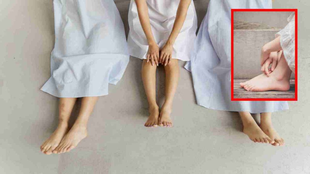 Cracked Feet :