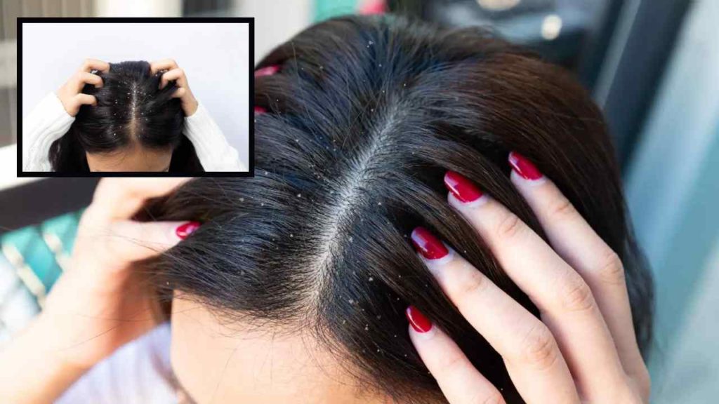 What Is Dandruff? Symptoms