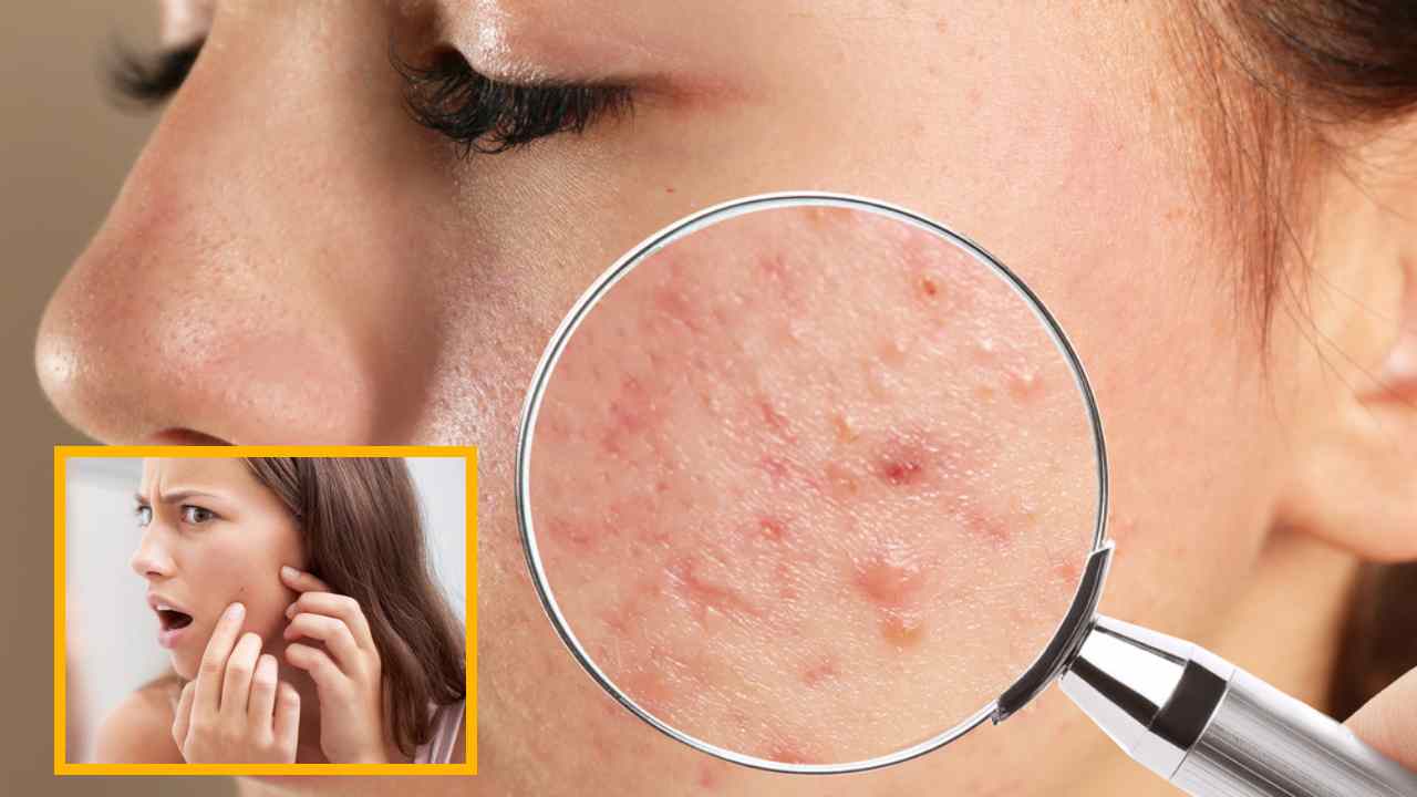 Prevent Acne : మొటిమలు ఎందుకు వస్తాయో తెలుసా ? అవి రాకుండా ఉండాలంటే ఏంచేయాలి? Prevent Acne : మొటిమలు ఎందుకు వస్తాయో తెలుసా ? అవి రాకుండా ఉండాలంటే ఏంచేయాలి?
