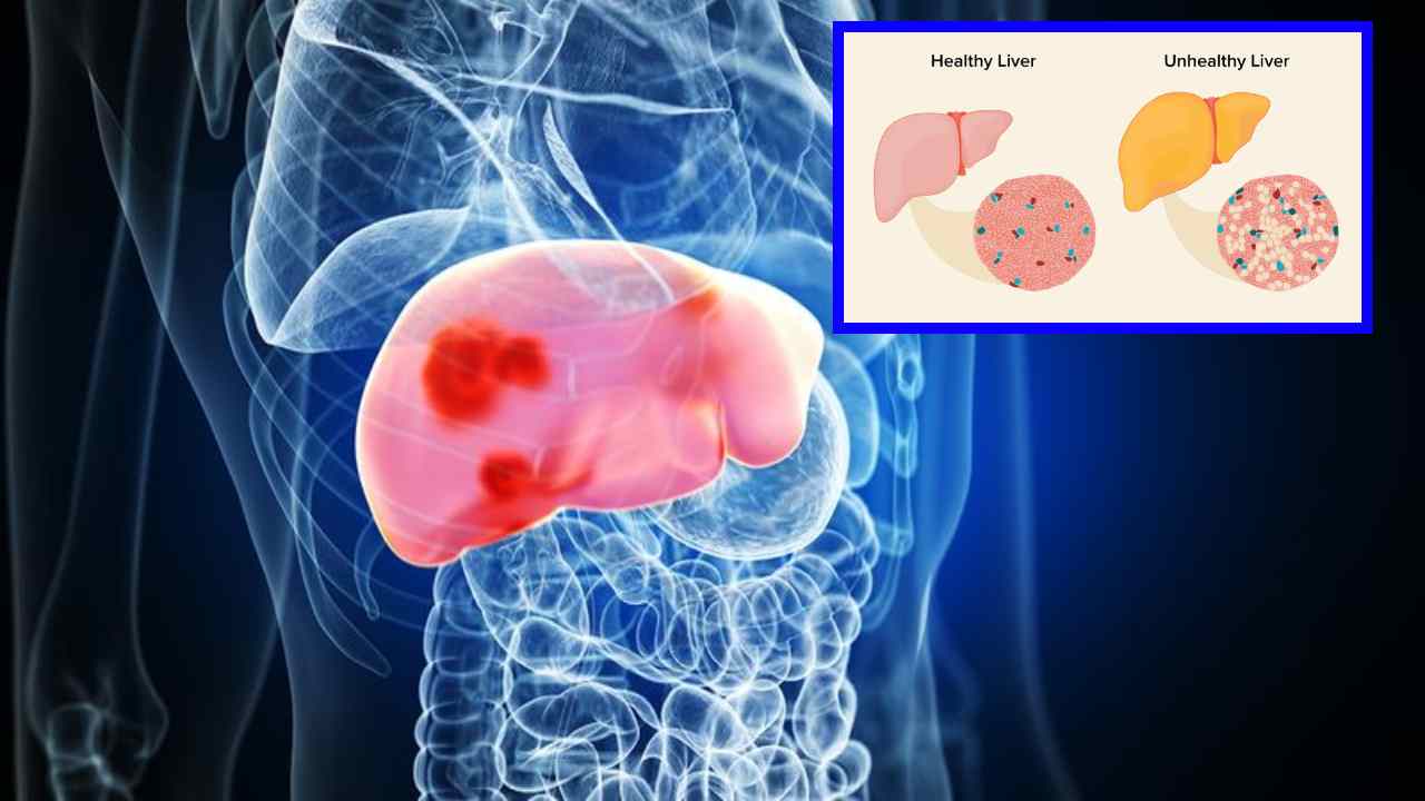 Non-Alcoholic Fatty Liver : నాన్-ఆల్కహాలిక్ ఫ్యాటీ లివర్ సమస్యా? ఎందుకిలా ? Non-Alcoholic Fatty Liver : నాన్-ఆల్కహాలిక్ ఫ్యాటీ లివర్ సమస్యా? ఎందుకిలా ?