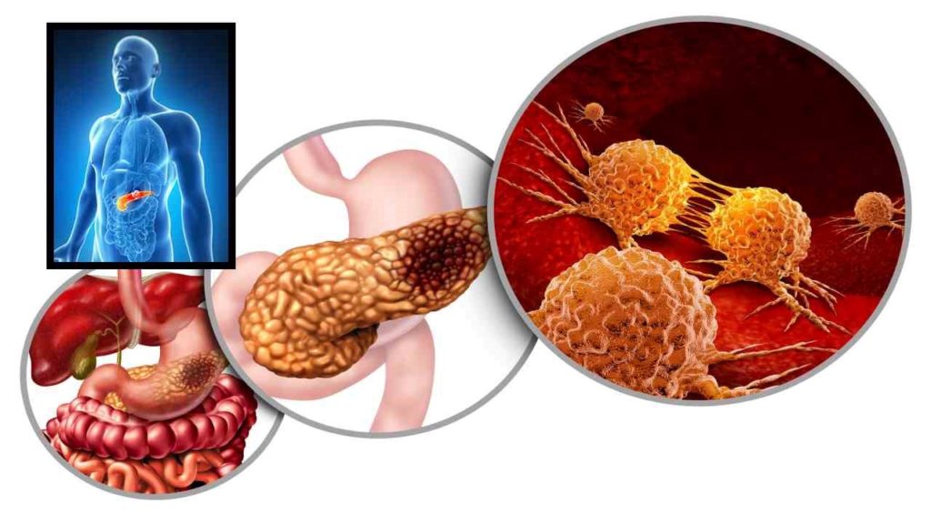 Pancreatic cancer