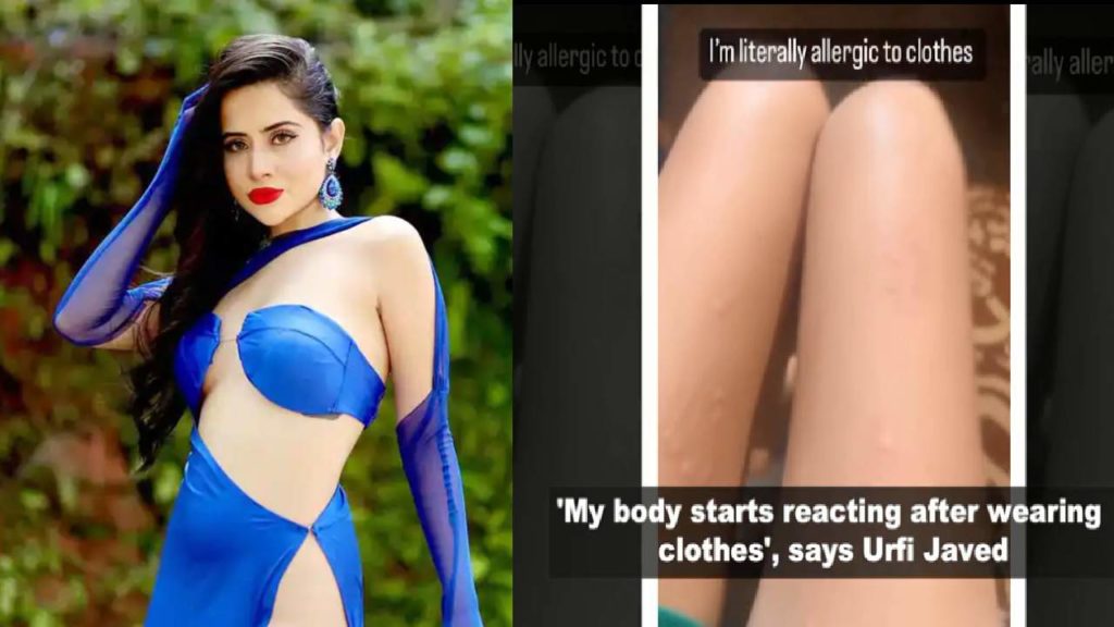 Urfi Javed says that the reason for doing the bold show is allergy