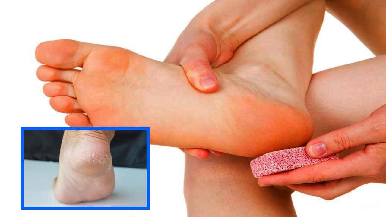 Cracked Heels : పాదాల పగుళ్ల సమస్యతో బాధపడుతున్నారా? పైనాపిల్ తో ఇలా చేసి చూడండి! Cracked Heels : పాదాల పగుళ్ల సమస్యతో బాధపడుతున్నారా? పైనాపిల్ తో ఇలా చేసి చూడండి!