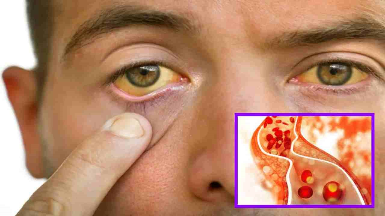 High Cholesterol Problem : అధిక కొలెస్ట్రాల్ సమస్య ఉంటే కనిపించే లక్షణాలు ఇవే ! High Cholesterol Problem : అధిక కొలెస్ట్రాల్ సమస్య ఉంటే కనిపించే లక్షణాలు ఇవే !