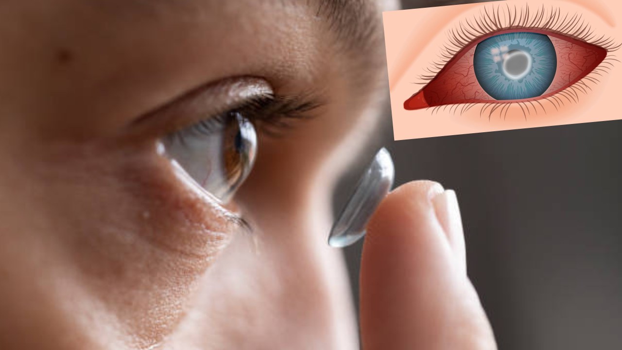 Contact Lenses : కాంటాక్ట్ లెన్స్ తీయకుండానే నిద్రపోటంతో కన్నునే పోగొట్టుకున్న యువకుడు Contact Lenses : కాంటాక్ట్ లెన్స్ తీయకుండానే నిద్రపోటంతో కన్నునే పోగొట్టుకున్న యువకుడు