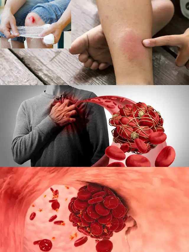 >రక్త నాళాల్లో క్లాట్లతో ప్రమాదం