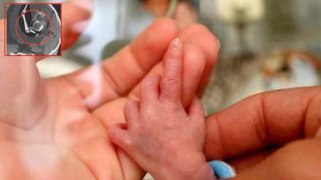 Unborn Twin In One Year Baby Brain