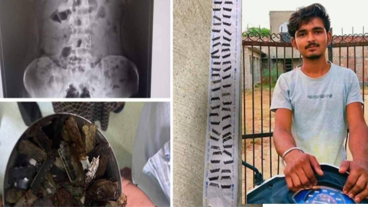 Rajasthan : 26 ఏళ్ల యువకుడి కడుపులో 56 బ్లేడ్లు .. షాక్ అయిన డాక్టర్లు Rajasthan : 26 ఏళ్ల యువకుడి కడుపులో 56 బ్లేడ్లు .. షాక్ అయిన డాక్టర్లు