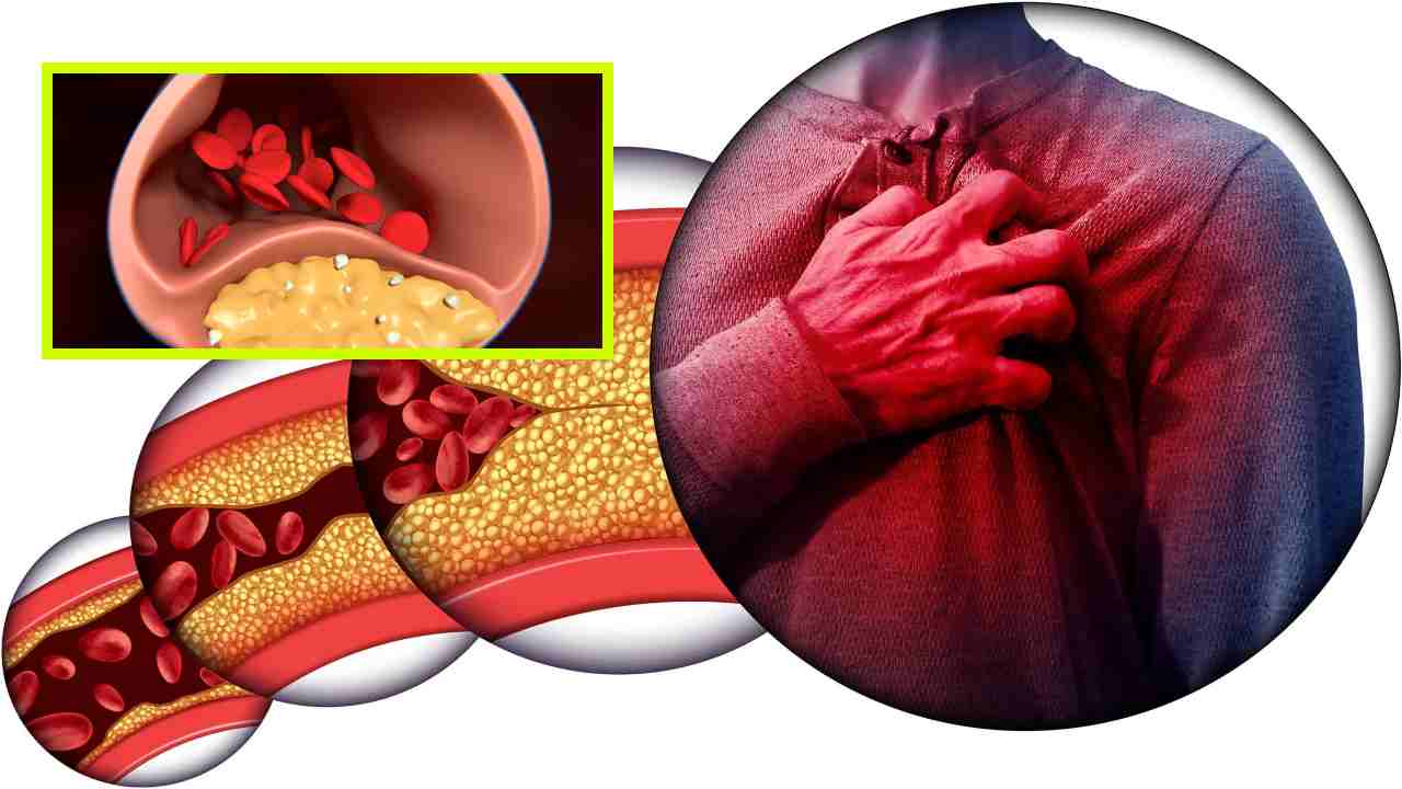 High Cholesterol : అధిక కొలెస్ట్రాల్ సమస్య గురించి కళ్లు, కాళ్ళు, నాలుకలో కనిపించే 5 సంకేతాలు ! High Cholesterol : అధిక కొలెస్ట్రాల్ సమస్య గురించి కళ్లు, కాళ్ళు, నాలుకలో కనిపించే 5 సంకేతాలు !